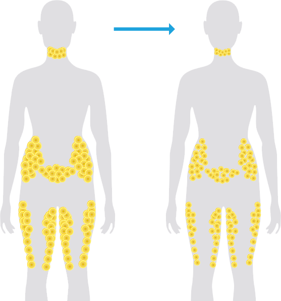 Hips Back Fat Loss Treatment Men - LA Lipo Cryolipolysis